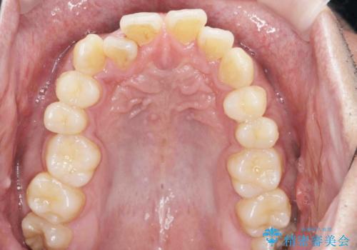 [ インビザライン矯正 ]  マウスピースで治す、すきっ歯　がたつきの治療前