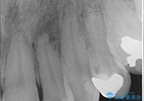 [ ジルコニアセラミッククラウン] 神経の死んだ前歯の治療の治療前