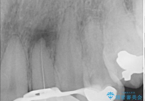 [ ジルコニアセラミッククラウン] 神経の死んだ前歯の治療の治療前