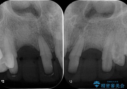 [ 全て歯を抜かなければいけないと言われた] 矯正治療を含む包括的歯周病治療の治療中