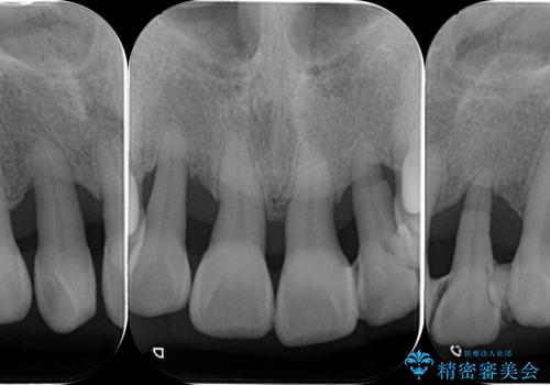 [ 全て歯を抜かなければいけないと言われた] 矯正治療を含む包括的歯周病治療の治療前