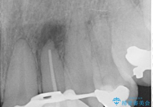 [ ジルコニアセラミッククラウン] 神経の死んだ前歯の治療の治療中