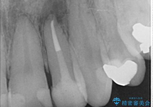 [ ジルコニアセラミッククラウン] 神経の死んだ前歯の治療の治療後