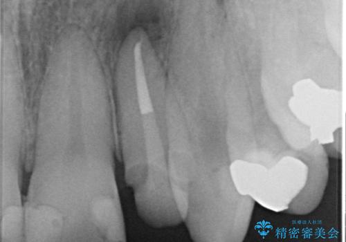 [ ジルコニアセラミッククラウン] 神経の死んだ前歯の治療の治療中