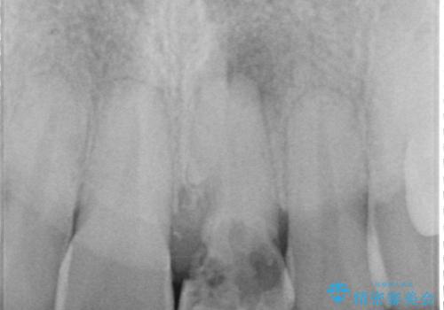 歯根吸収した前歯　短期間でのインプラント治療の治療前