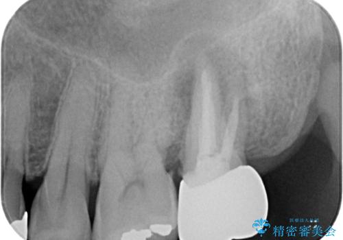 腫れて痛む奥歯 抜歯を覚悟した歯のむし歯治療の治療前