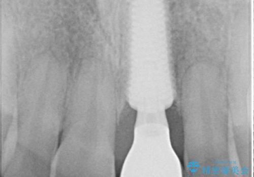 歯根吸収した前歯　短期間でのインプラント治療の治療後