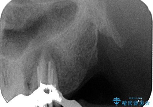 腫れて痛む奥歯 抜歯を覚悟した歯のむし歯治療の治療中