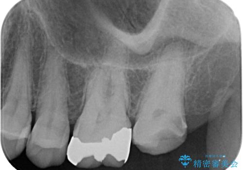 放置した奥歯のむし歯 ゴールドクラウン補綴治療の治療前