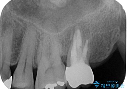 腫れて痛む奥歯　抜歯を覚悟した歯のむし歯治療の治療後