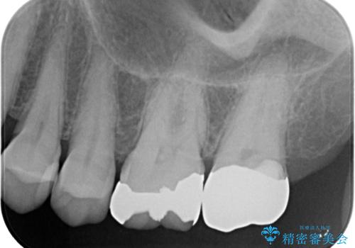 放置した奥歯のむし歯　ゴールドクラウン補綴治療の治療後