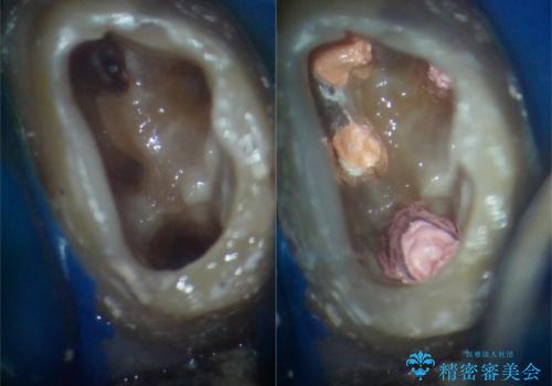 腫れて痛む奥歯 抜歯を覚悟した歯のむし歯治療の治療中