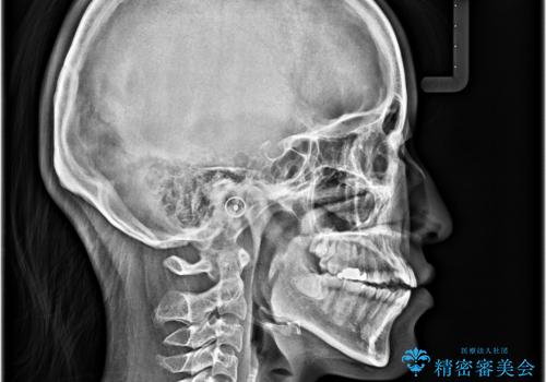 舌の突出癖が原因　インビザライン矯正による開咬改善の治療前