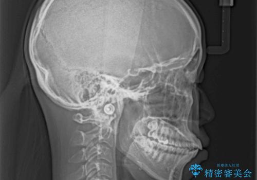 飛び出した前歯を引っ込める　ワイヤー装置での抜歯矯正治療の治療前