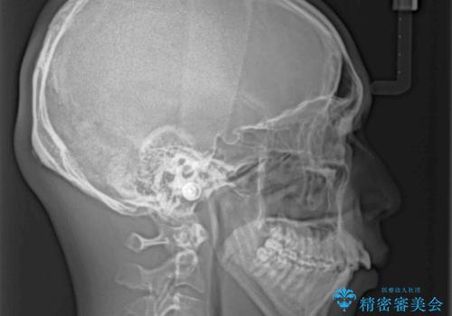 狭くて前方に飛び出した歯列 拡大装置を併用したワイヤー抜歯矯正治療の治療前