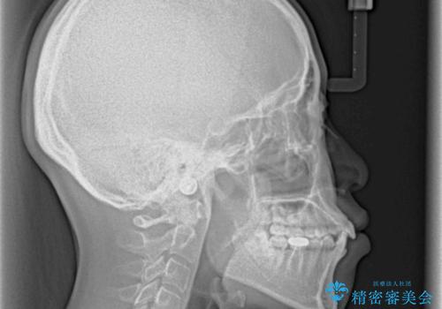 口ゴボが気になる　上下4本の抜歯矯正の治療前