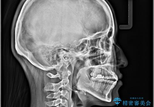 舌の突出癖が原因　インビザライン矯正による開咬改善の治療後