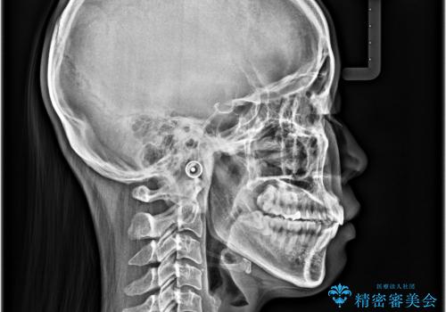 飛び出した前歯を引っ込める　ワイヤー装置での抜歯矯正治療の治療後