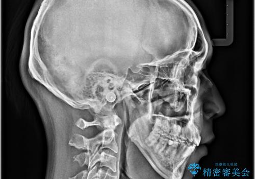 狭くて前方に飛び出した歯列　拡大装置を併用したワイヤー抜歯矯正治療の治療後