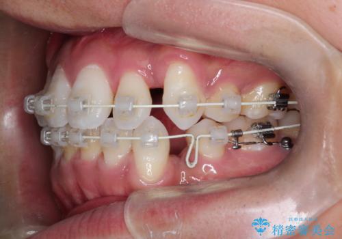 前歯の突出を防ぎながらガタつきを解消。上下左右4番抜歯による審美ワイヤー矯正の治療中