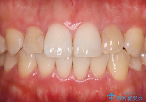 歯に食べ物がはさまる　色も揃えたい　オールセラミックで治療の治療前