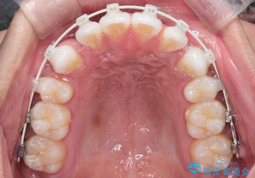 前歯の突出を防ぎながらガタつきを解消。上下左右4番抜歯による審美ワイヤー矯正の治療中
