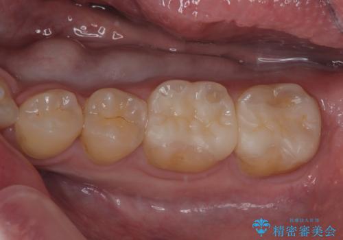 銀歯を白くしたい　セラミックインレー修復の症例 治療後