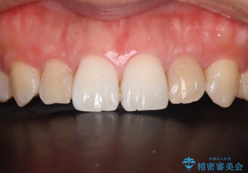 歯に食べ物がはさまる 色も揃えたい オールセラミックで治療の治療前