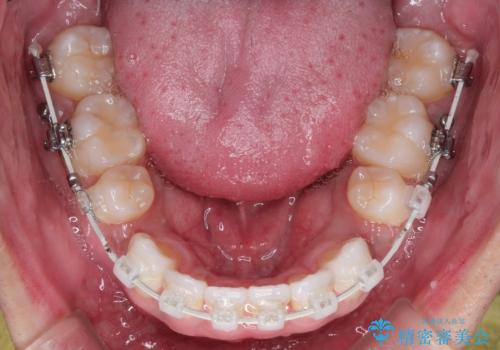 前歯の突出を防ぎながらガタつきを解消。上下左右4番抜歯による審美ワイヤー矯正の治療中