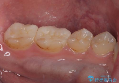 銀歯を白くしたい セラミックインレー修復の治療後