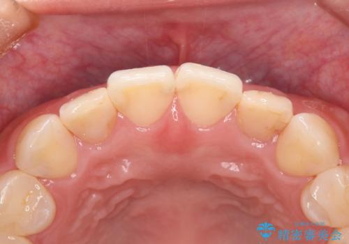 歯に食べ物がはさまる 色も揃えたい オールセラミックで治療の治療前