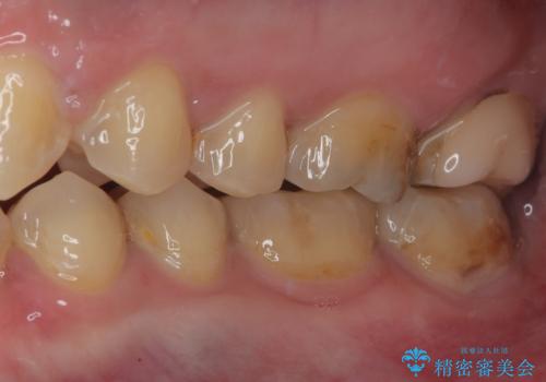 銀歯を白くしたい セラミックインレー修復の治療後