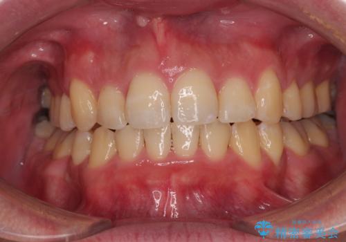 狭くて前方に飛び出した歯列 拡大装置を併用したワイヤー抜歯矯正治療の治療後