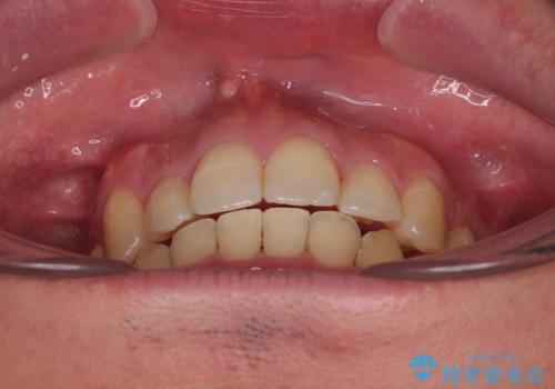 狭くて前方に飛び出した歯列 拡大装置を併用したワイヤー抜歯矯正治療の治療後