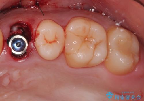 根元から折れてしまった歯をどうする?矯正かインプラントかを比較検討した症例の治療中