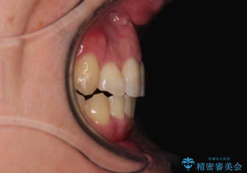 狭くて前方に飛び出した歯列　拡大装置を併用したワイヤー抜歯矯正治療の治療後