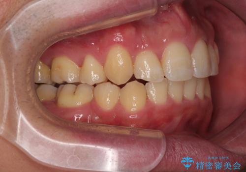 狭くて前方に飛び出した歯列　拡大装置を併用したワイヤー抜歯矯正治療の治療後