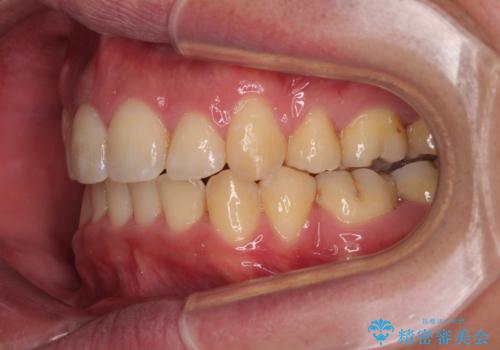 狭くて前方に飛び出した歯列　拡大装置を併用したワイヤー抜歯矯正治療の治療後