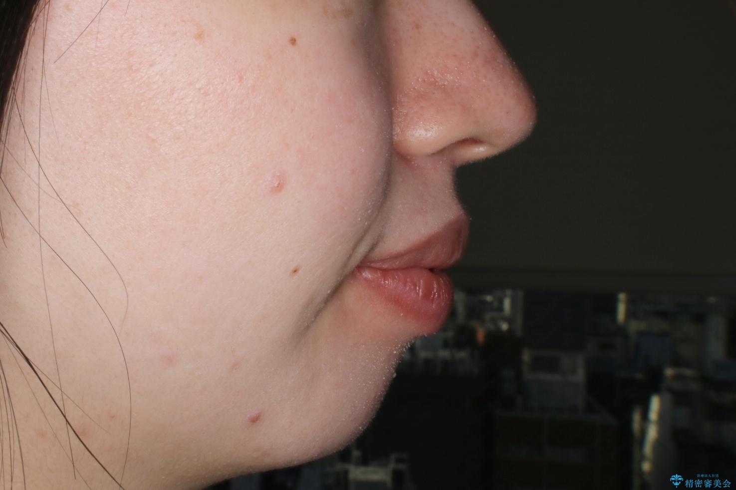 【審美装置】口元を下げたいの治療前(顔貌)