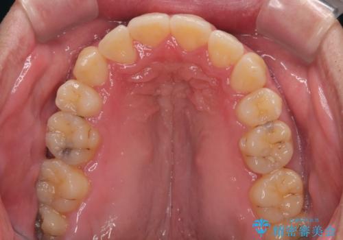 狭くて前方に飛び出した歯列 拡大装置を併用したワイヤー抜歯矯正治療の治療後