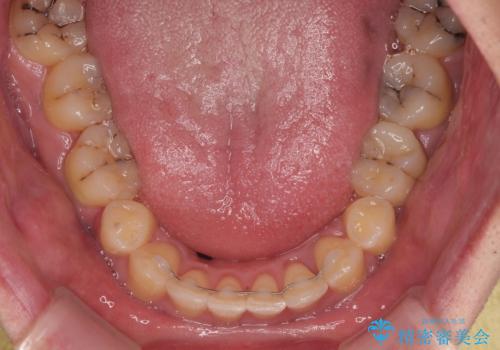 狭くて前方に飛び出した歯列　拡大装置を併用したワイヤー抜歯矯正治療の治療後