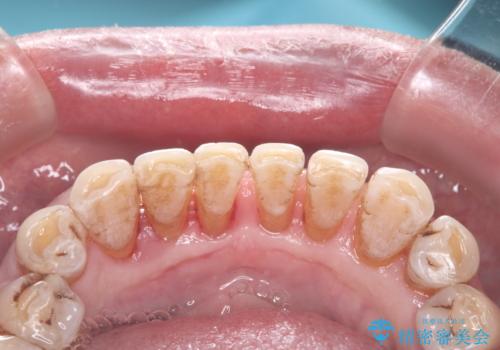 クリーニングでスッキリ!の治療後