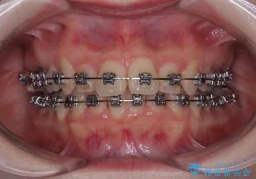 飛び出した前歯を引っ込める ワイヤー装置の非抜歯矯正の治療中