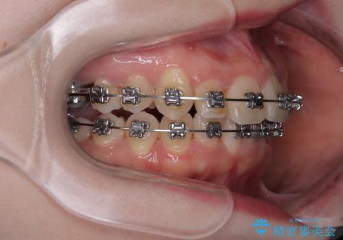 飛び出した前歯を引っ込める ワイヤー装置の非抜歯矯正の治療中