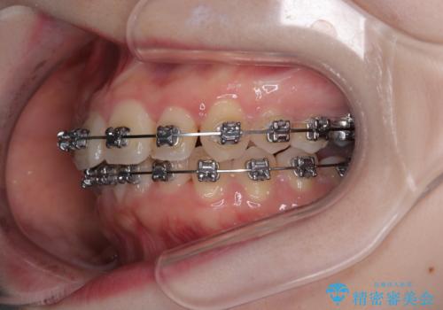 飛び出した前歯を引っ込める ワイヤー装置の非抜歯矯正の治療中