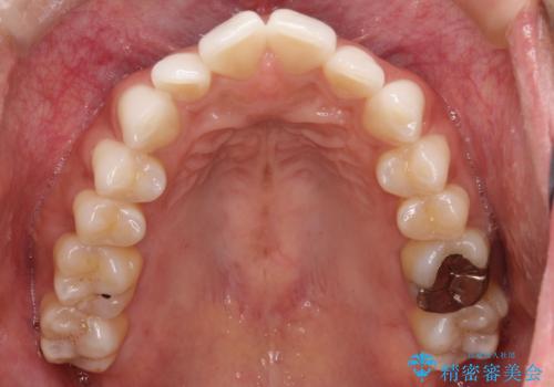 前歯のがたつきをマウスピース矯正で改善。IPRと遠心移動による非抜歯インビザライン治療の治療前