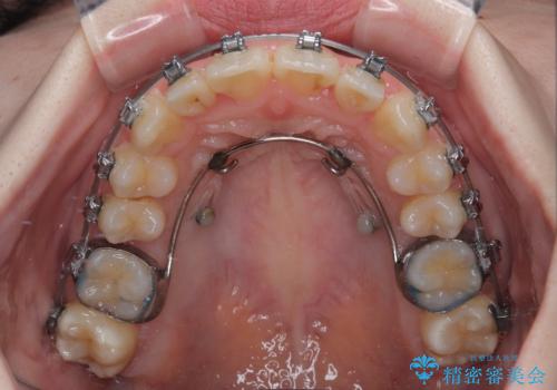 飛び出した前歯を引っ込める　ワイヤー装置の非抜歯矯正の治療中