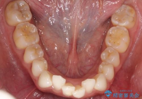 前歯のがたつきをマウスピース矯正で改善。IPRと遠心移動による非抜歯インビザライン治療の治療前