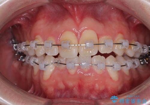 マウスピース矯正と迷った結果…管理のしやすさで選んだクリアブラケット矯正の症例の治療中