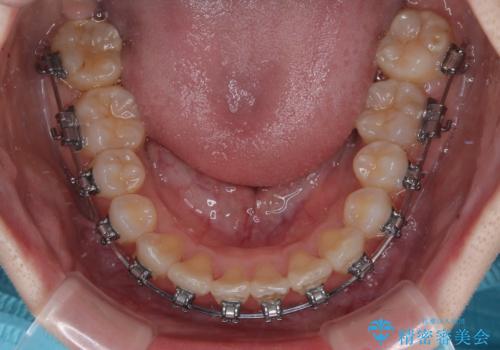 飛び出した前歯を引っ込める ワイヤー装置の非抜歯矯正の治療中